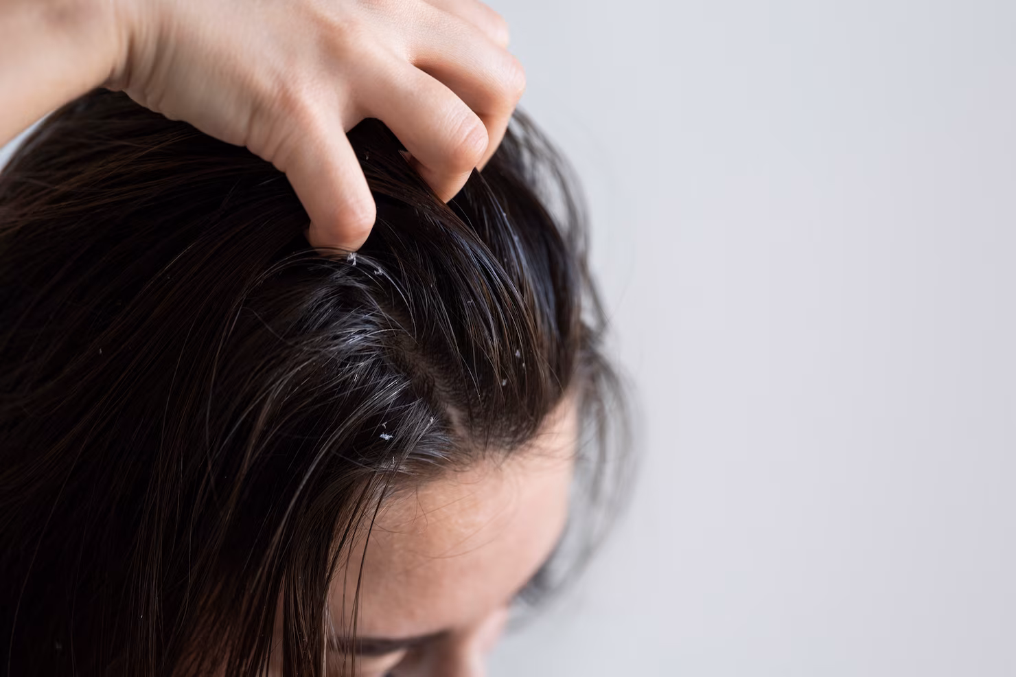 seasonal-dandruff-winter-care